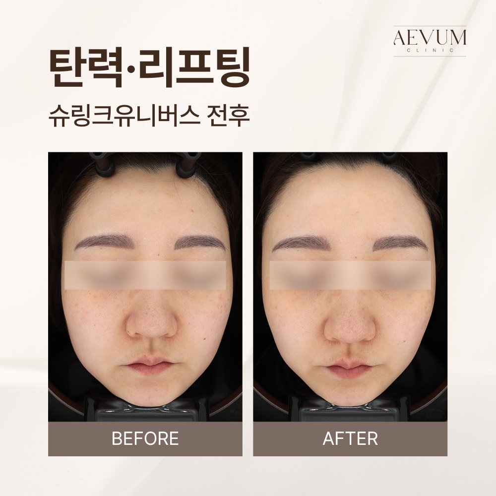 이수역피부과 슈링크 상담, 처음이라면 무엇부터 정할까