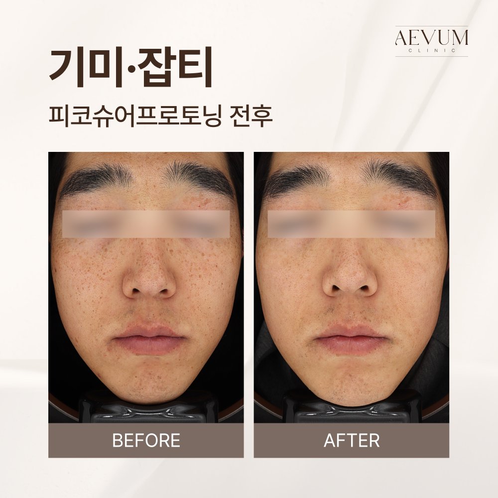 사당피부과 피코토닝 상담, 기미와 잡티 구분부터